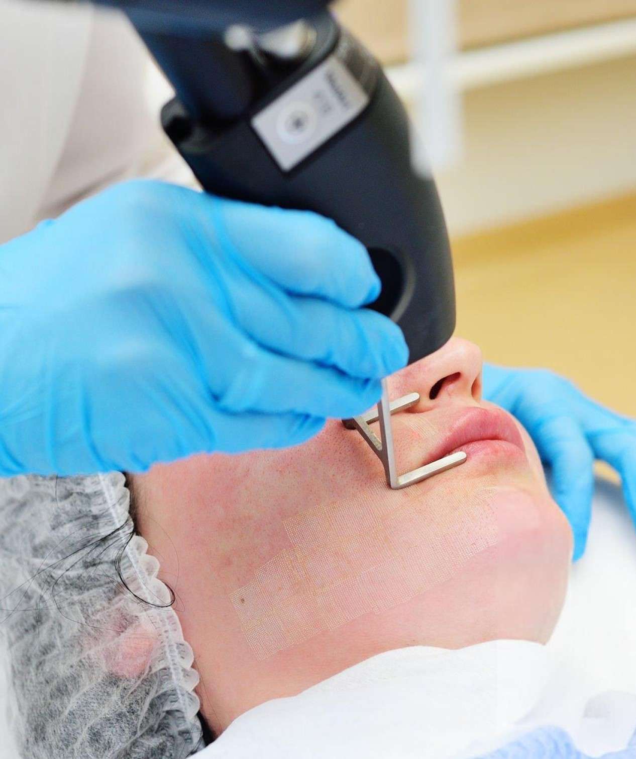 Professional CO₂ Fractional Laser treatment